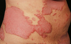 Psoriasis vor der Behandlung.