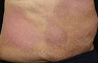 Psoriasis nach der Behandlung.