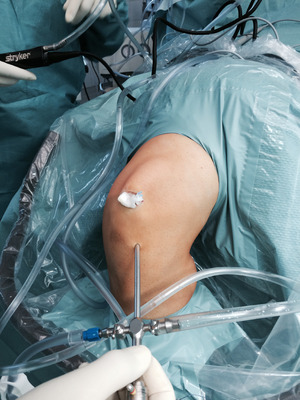 Im Zuge eines minimalinvasiven Eingriffs wird eine Sehne aus dem Oberschenkel entnommen und das Knie damit stabilisiert.