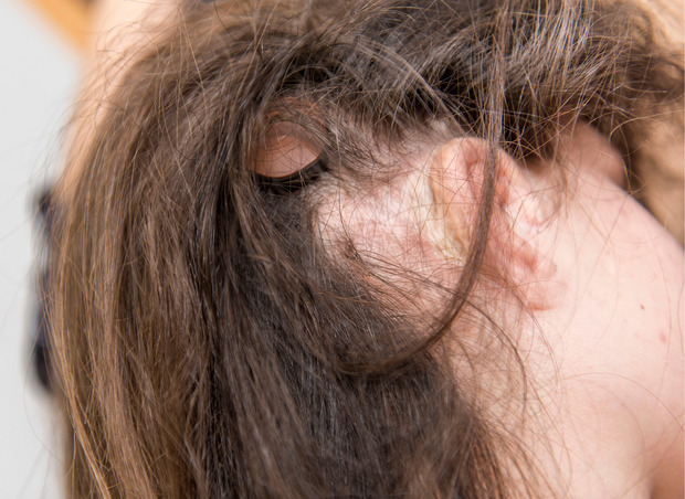 Ein Knopf über Selinas Ohr ist mit dem Hörgerät-Implantat verbunden.